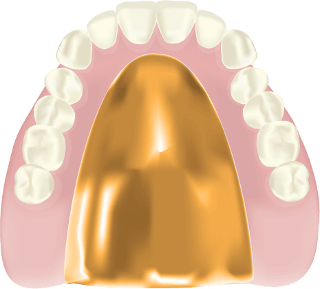 金属床入れ歯