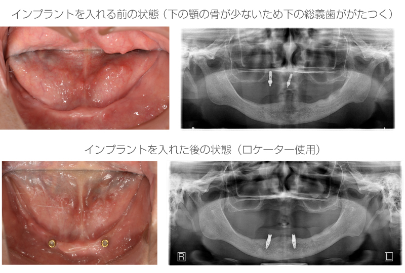 インプラントオーバーデンチャー症例