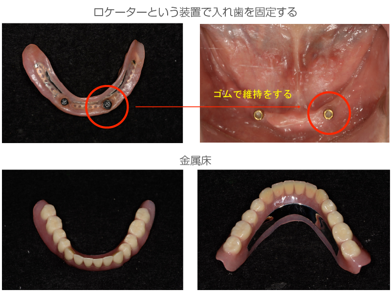 インプラントオーバーデンチャー症例