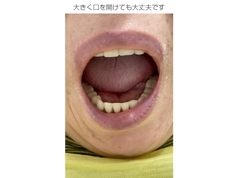 インプラントオーバーデンチャー症例