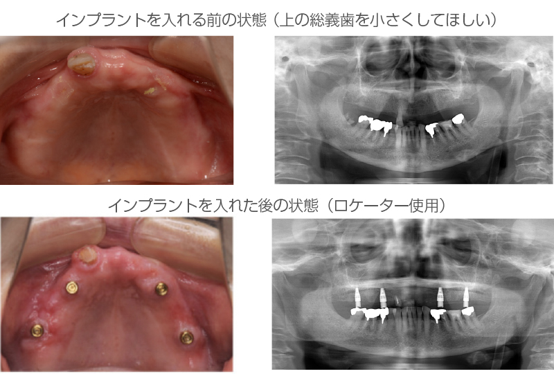 インプラントオーバーデンチャー症例