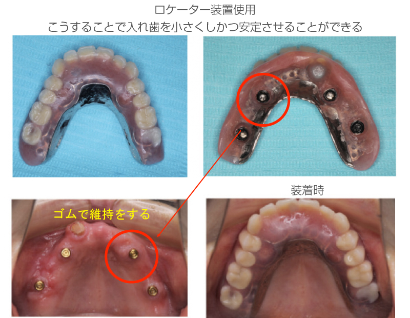 インプラントオーバーデンチャー症例