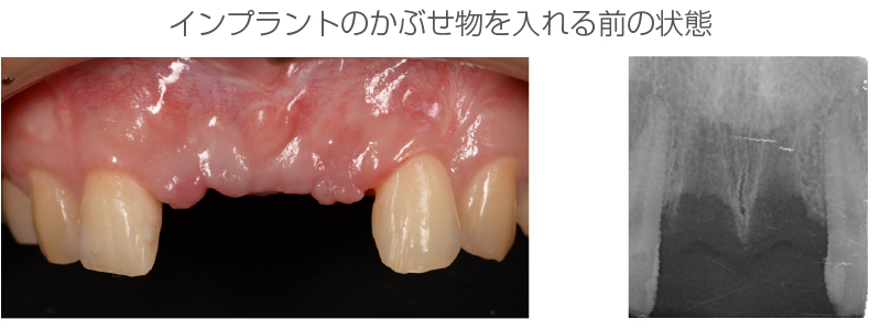 インプラント症例