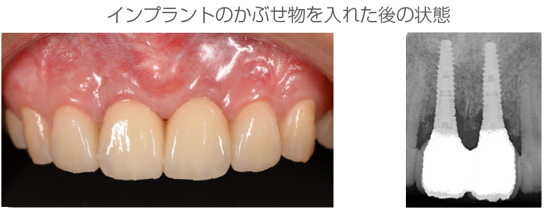 インプラント症例