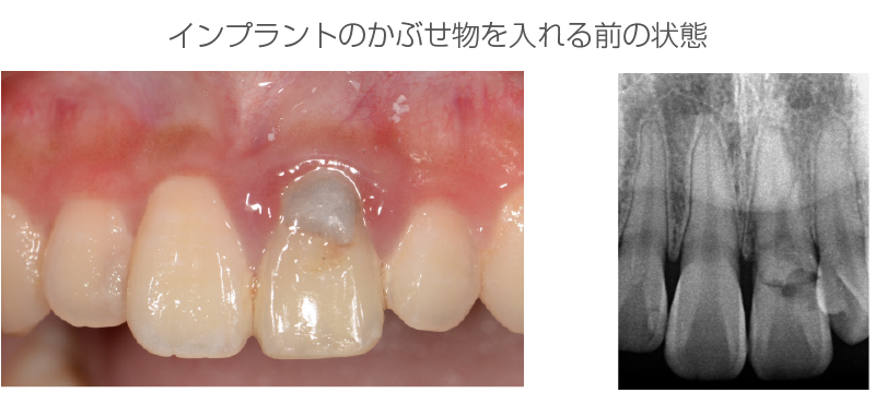 インプラント症例