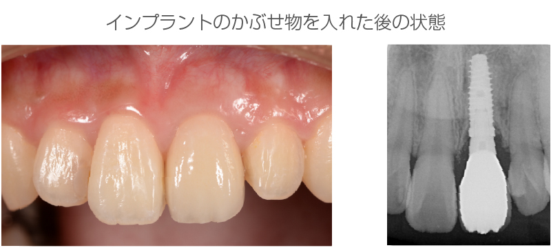 インプラント症例
