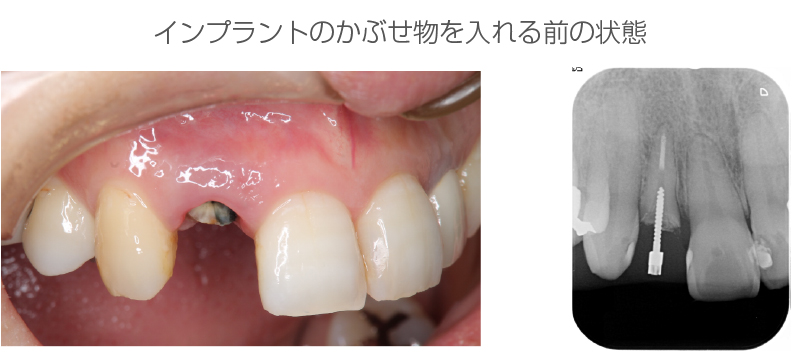 インプラント症例
