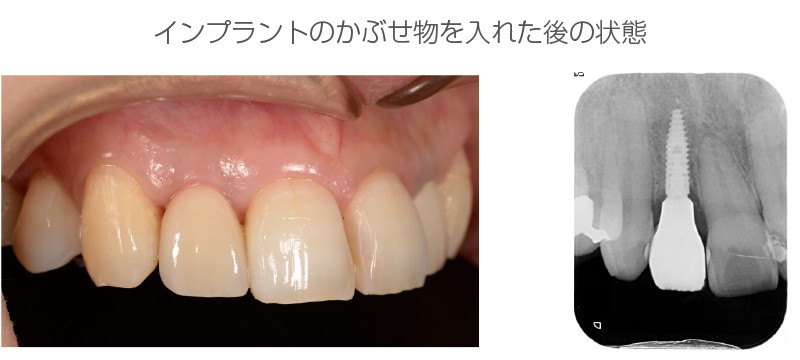 インプラント症例