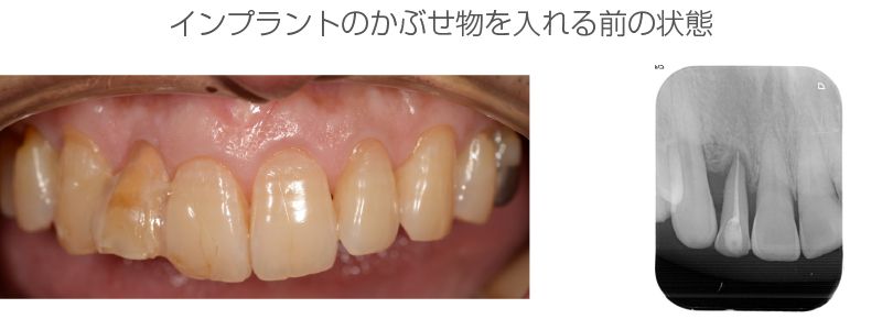 インプラント症例