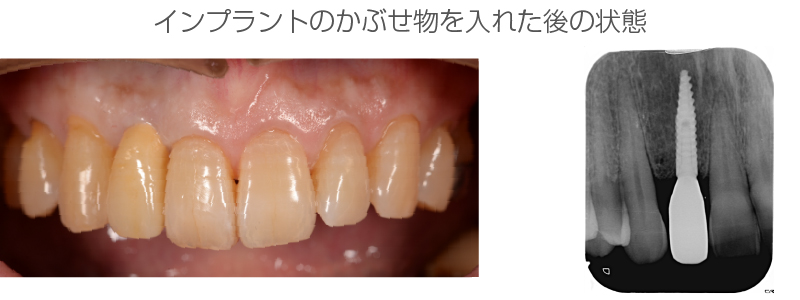インプラント症例