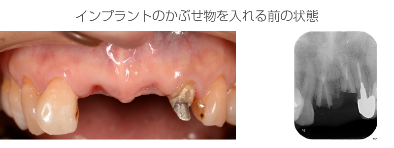 インプラント症例