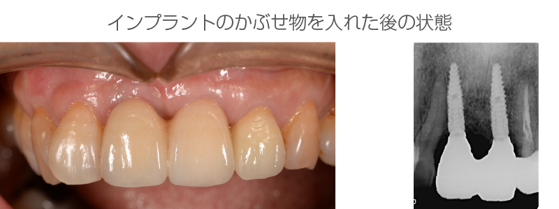 インプラント症例