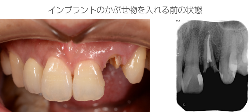 インプラント症例