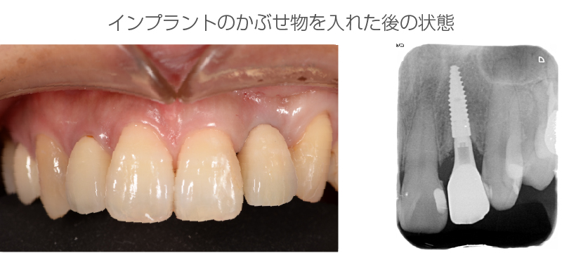 インプラント症例