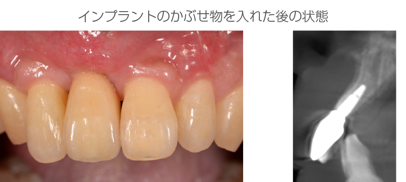 インプラント症例