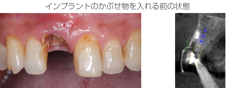 インプラント症例