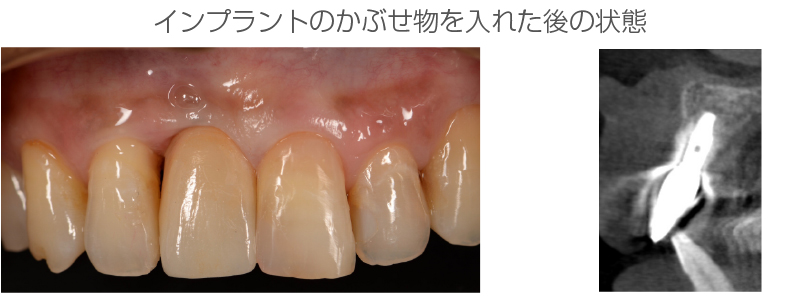 インプラント症例