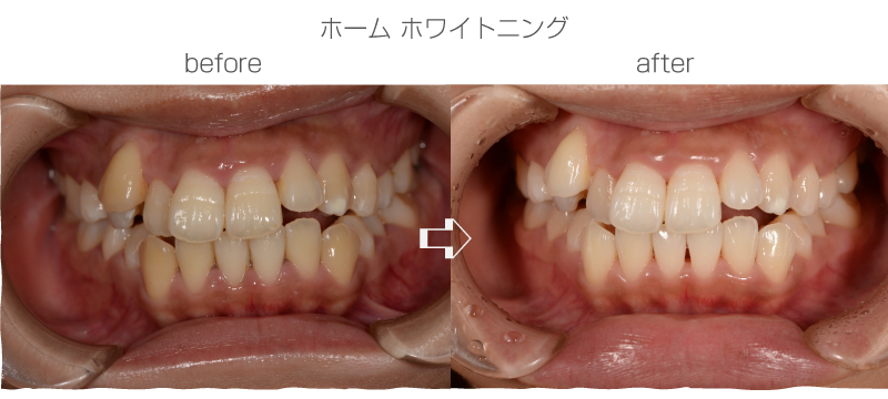 ホワイトニング症例