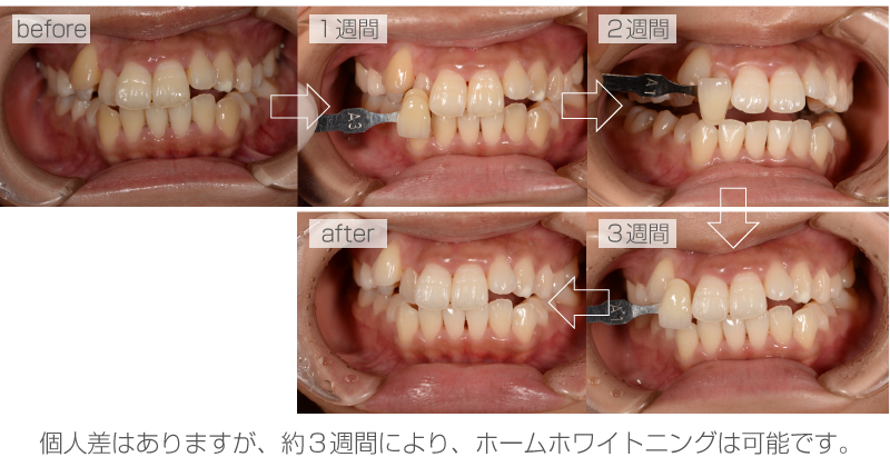 ホワイトニング症例
