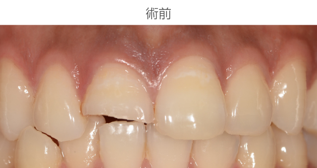 前歯審美症例