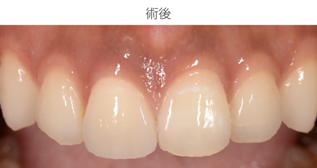 前歯審美症例