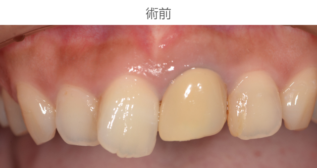 前歯審美症例
