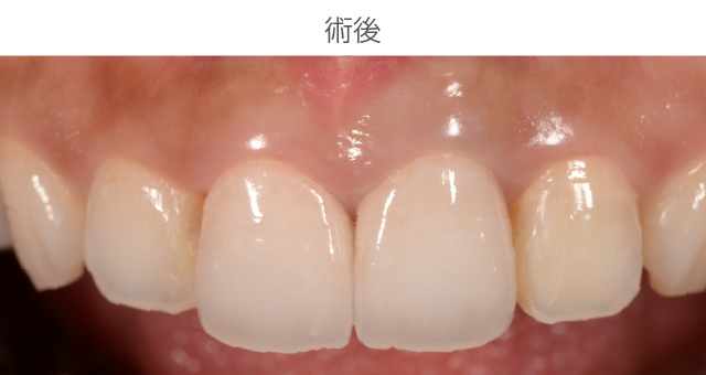 前歯審美症例