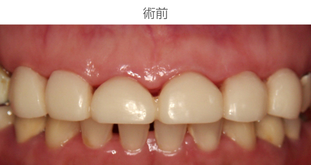前歯審美症例