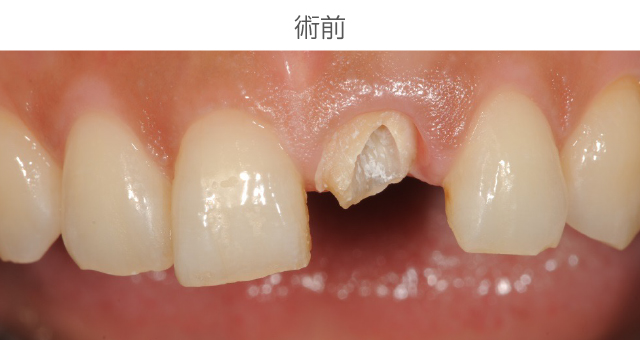 前歯審美症例