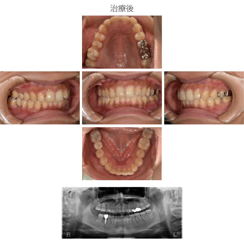 矯正症例