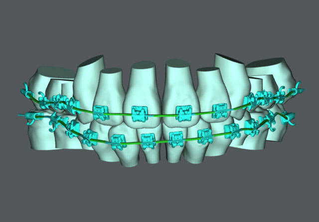 suresmile